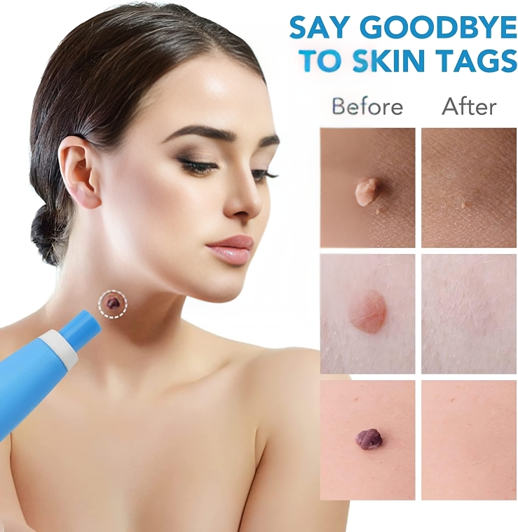 TagErase | Verwijder skin tags snel en veilig!
