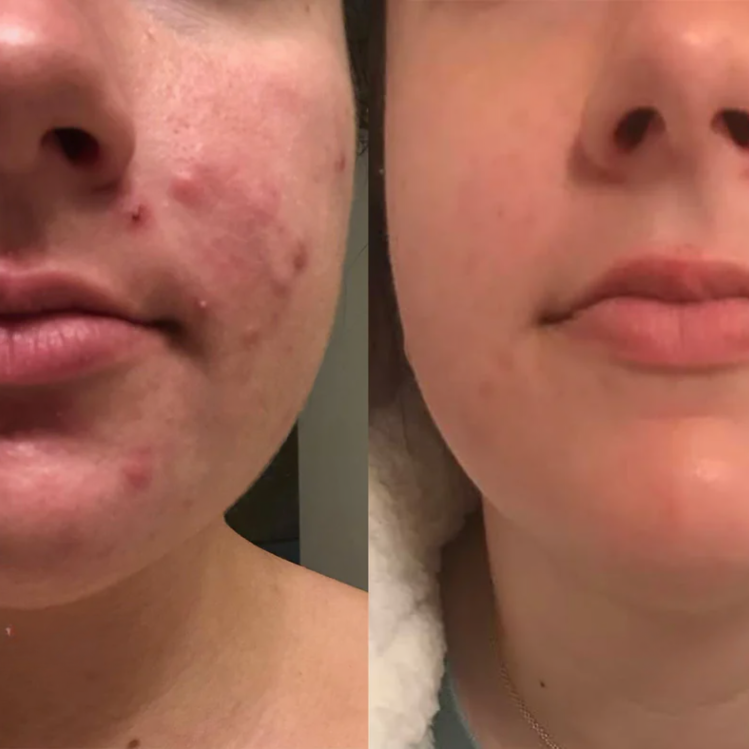 SkinMend | Silicone littekenvellen