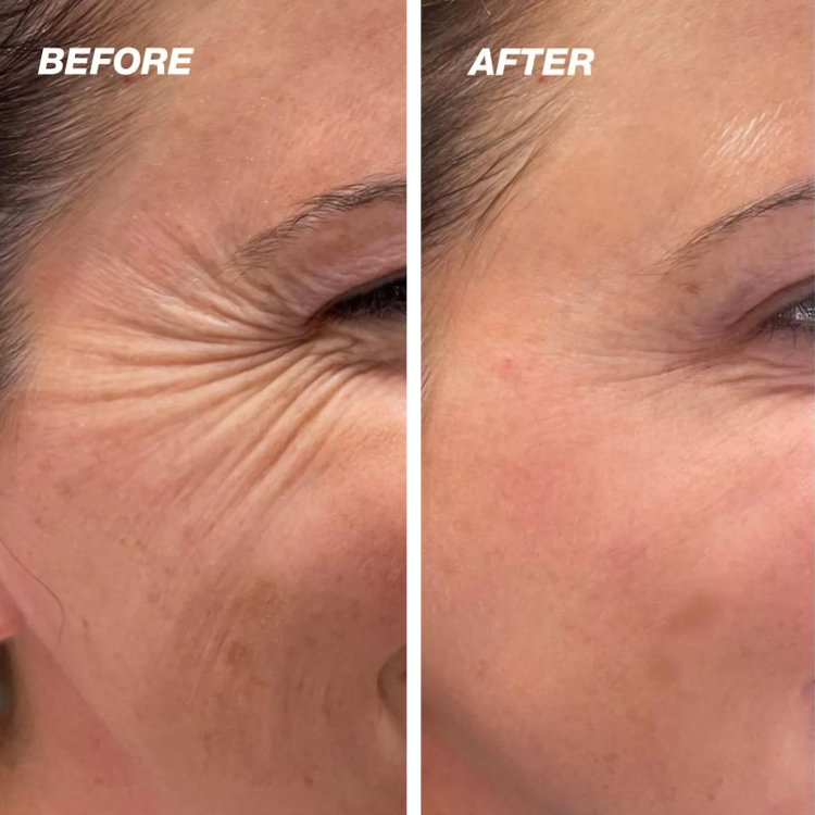 SkinMend | Silicone littekenvellen