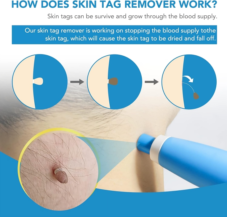 TagErase | Verwijder skin tags snel en veilig!