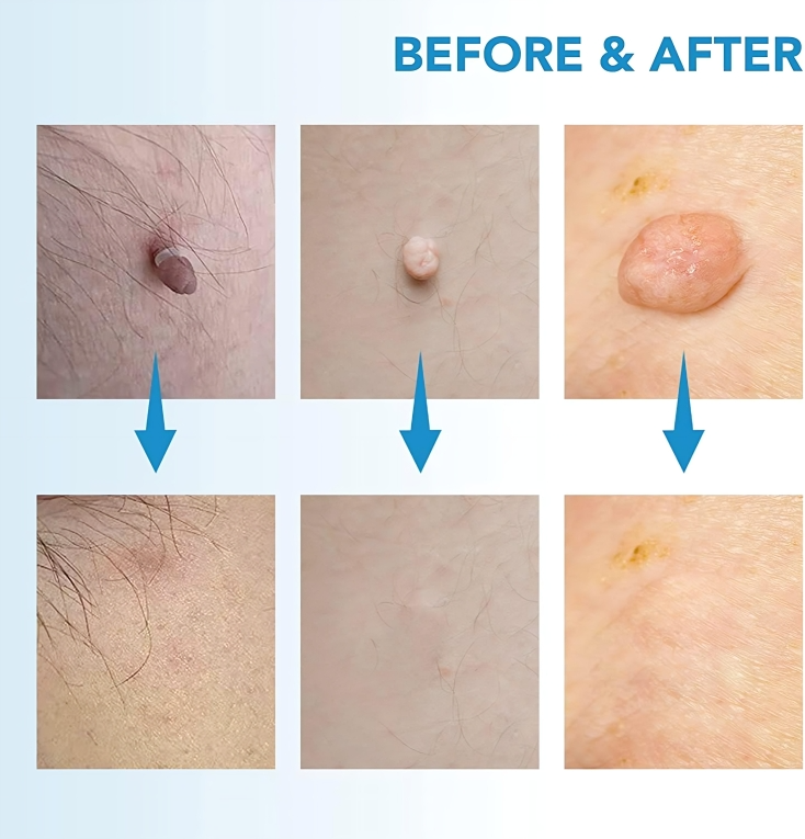 TagErase | Verwijder skin tags snel en veilig!