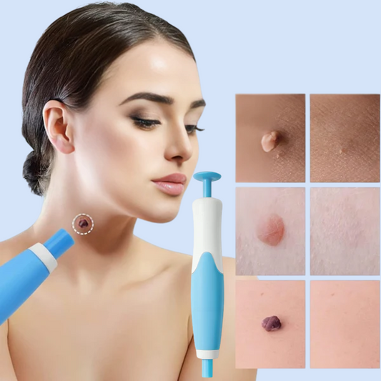 TagErase | Verwijder skin tags snel en veilig!