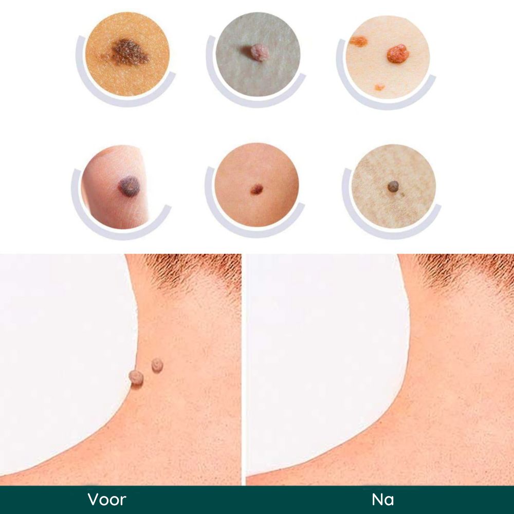 SkinClear | Snelle Verwijderingspatches