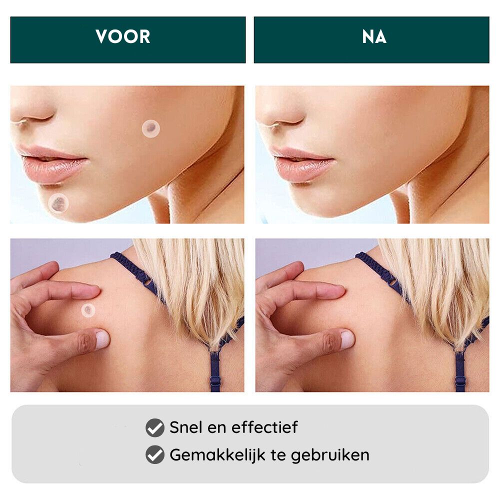 SkinClear | Snelle Verwijderingspatches