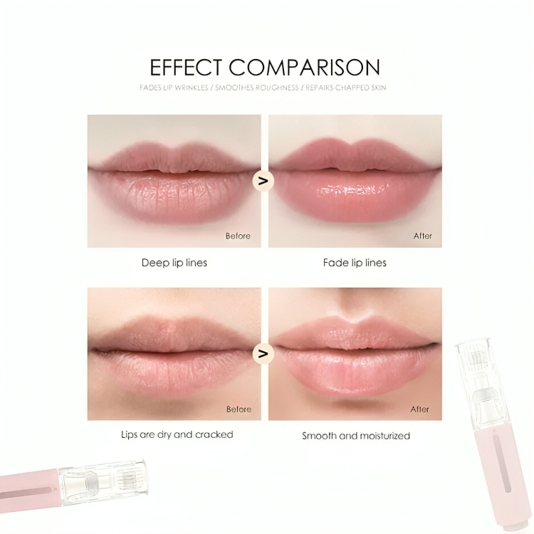 LipLift | Microneedle-lippenroller